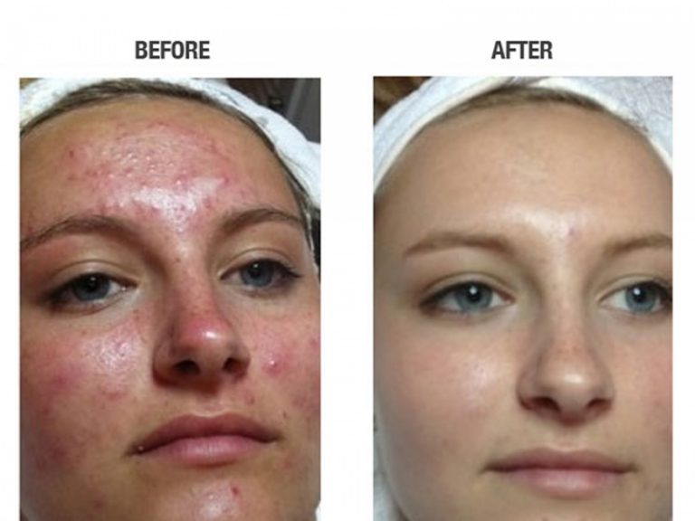 The pros and cons of Acne Laser Treatments - Medi Port Services